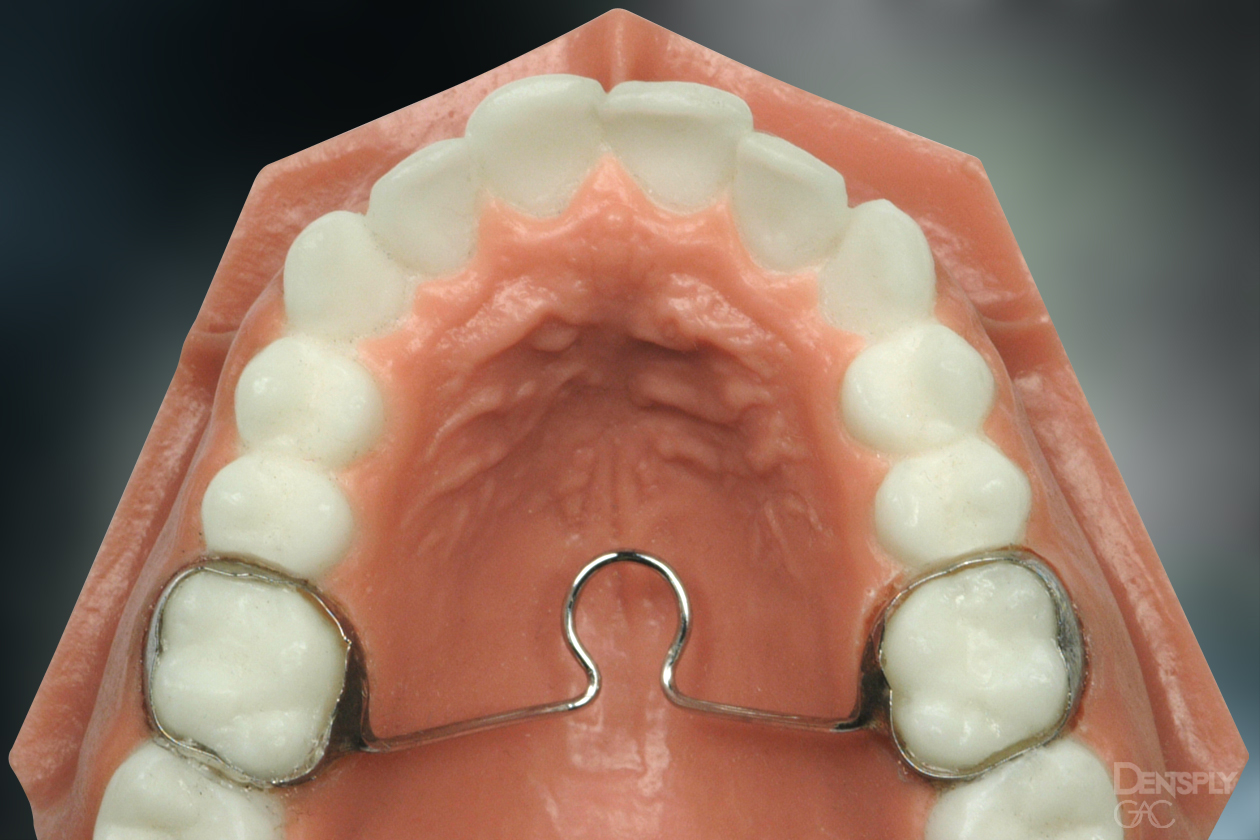 Palatal Holding Arch