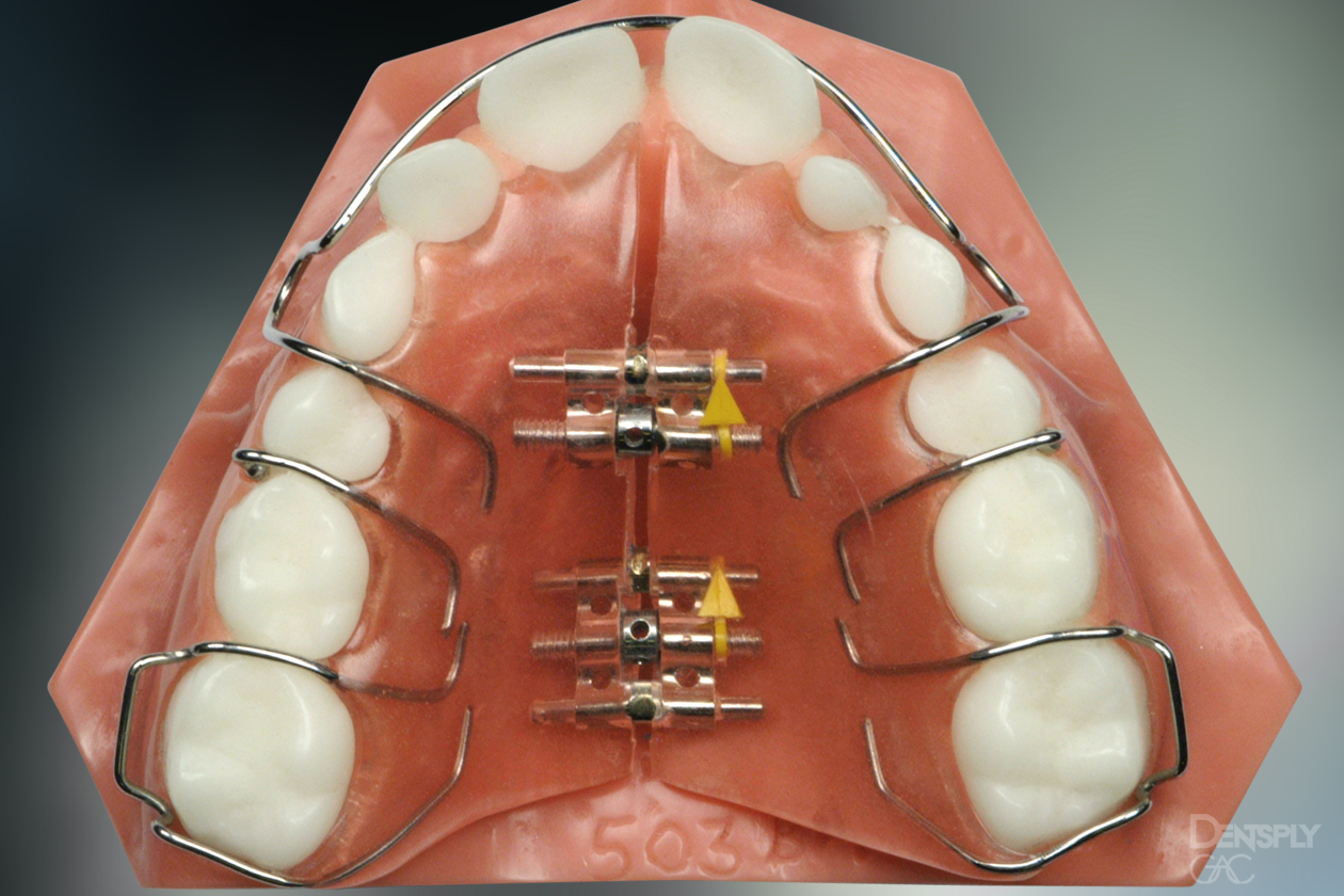 What to Expect With Your Child's Orthodontic Expander