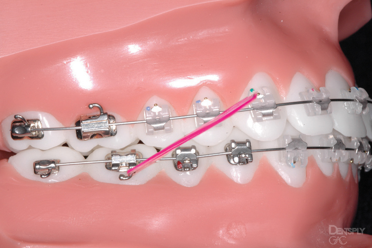 Demonstrates class 2 elastics on models of teeth. These are used to pull the upper front teeth back and the lower back teeth forwards.