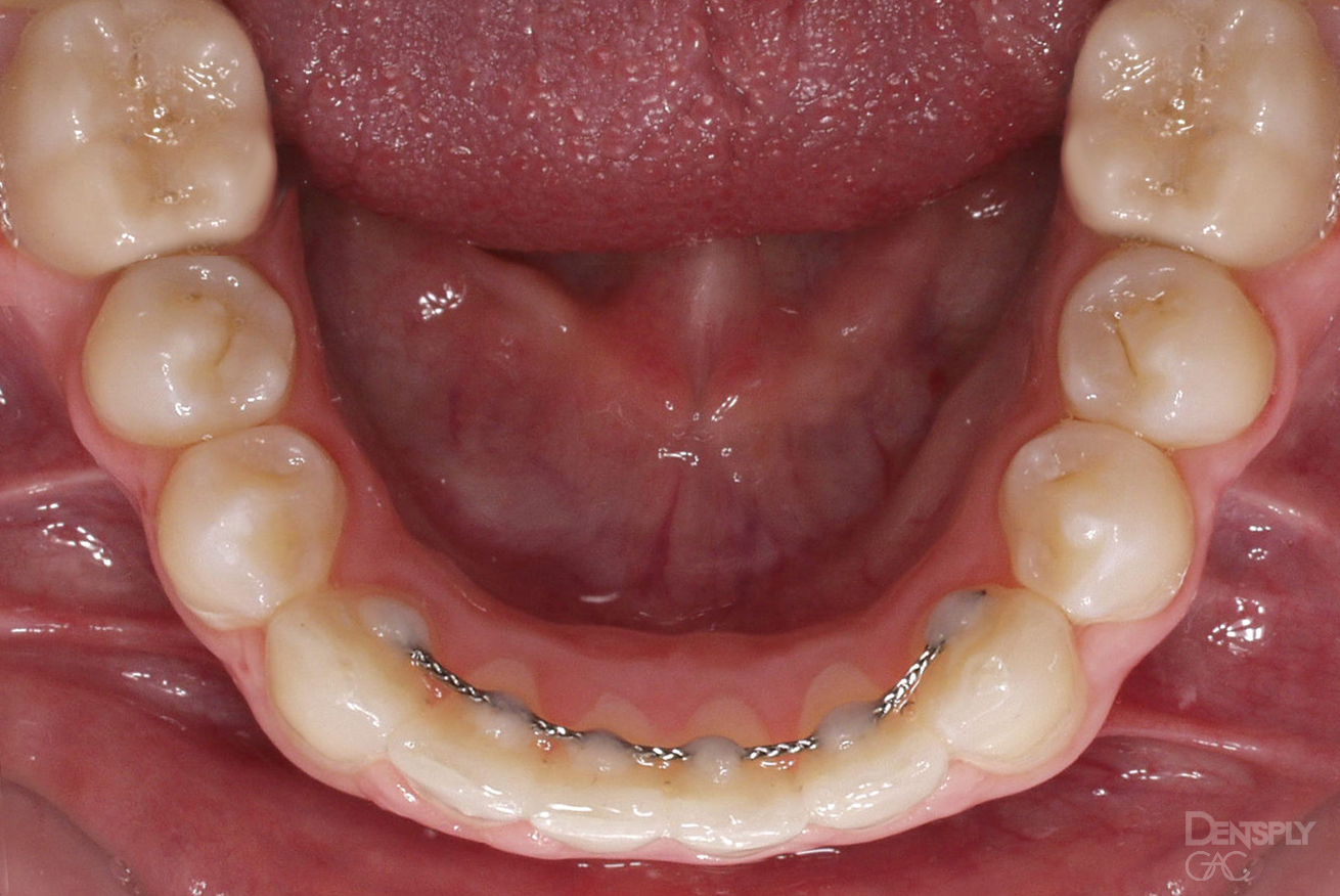 Demonstrates a lower fixed retainer, held in place by dental glue (composite).