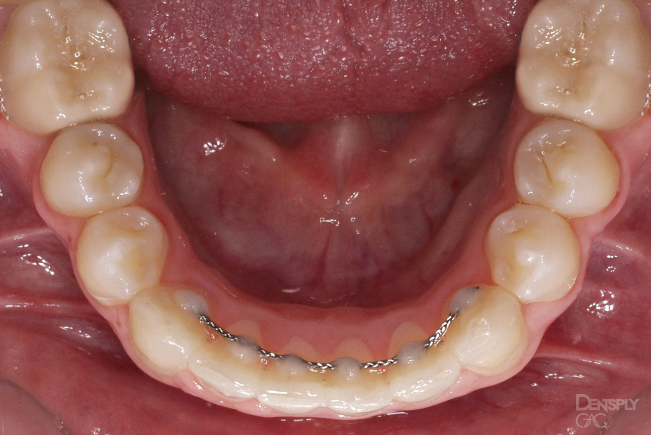 Can Metal Retainers Scratch Teeth at David Joseph blog