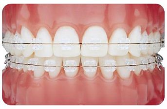 Private Orthodontic Treatments